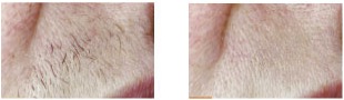 before and after laser hair removal at amachi medspa